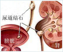患上膀胱结石的危害是什么